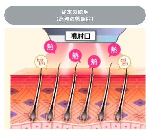 脱毛器について